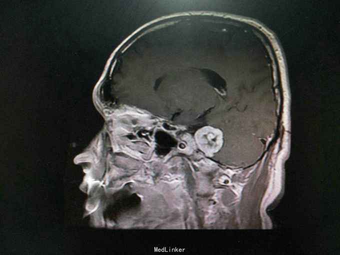 听神经鞘瘤一例