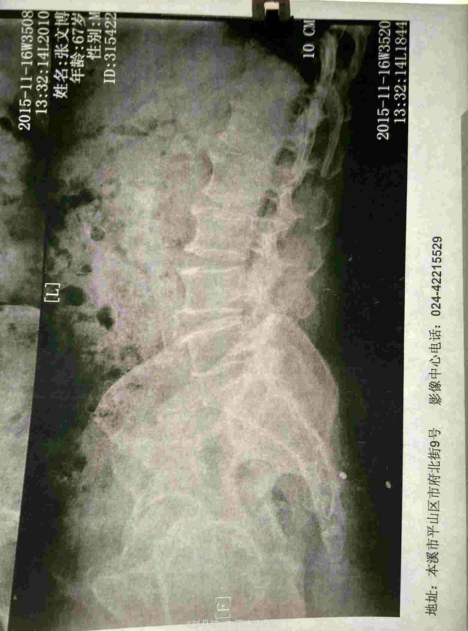 腰椎间盘突出症,骶管囊肿