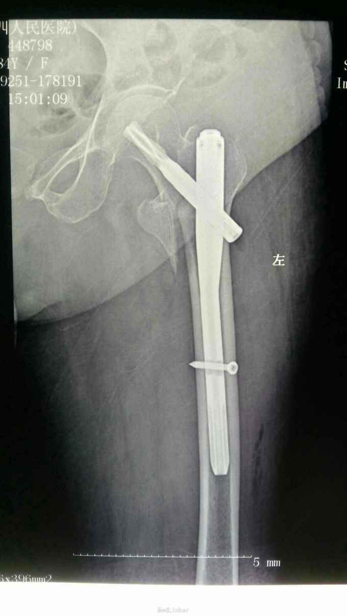 pfna治疗老年股骨粗隆间骨折一例
