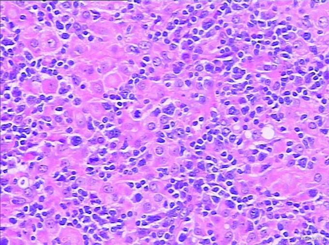 非特指性外周t细胞淋巴瘤(lennert lymphoma)