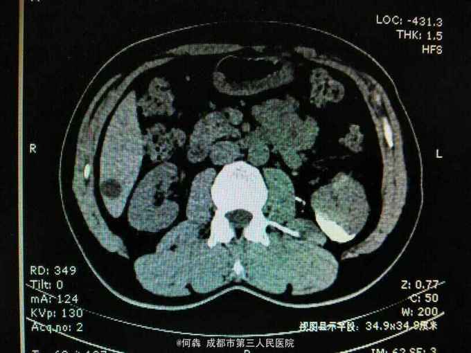 腹腔镜肾囊肿术后窦道形成伴感染一例