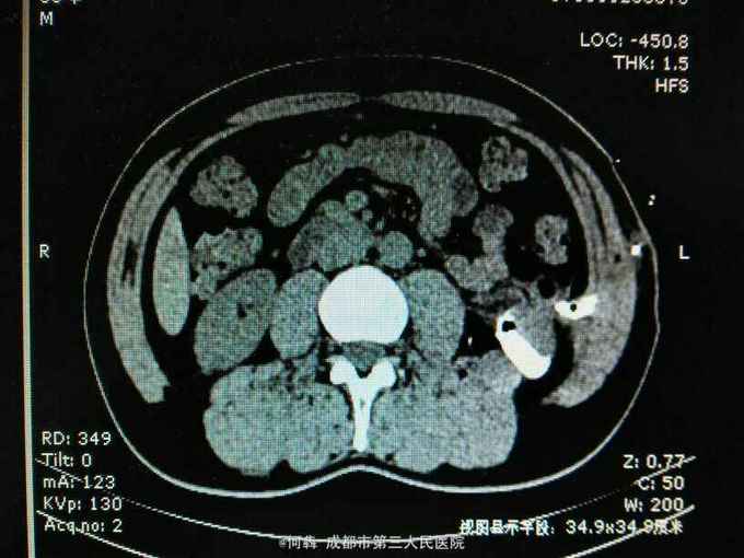 腹腔镜肾囊肿术后窦道形成伴感染一例