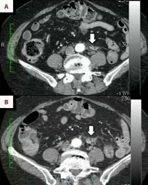 pet/ct 误诊大肠癌1例