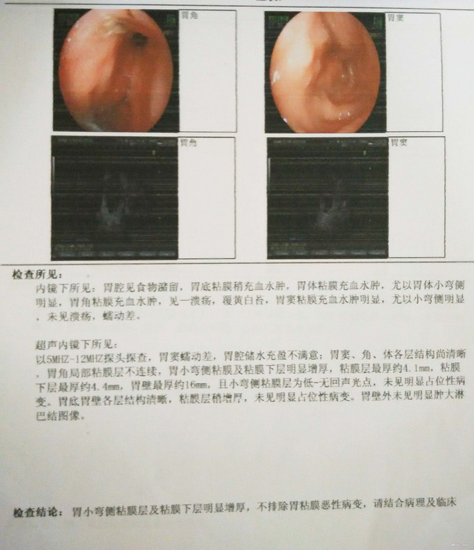 2次胃镜取活检终确诊胃癌1例