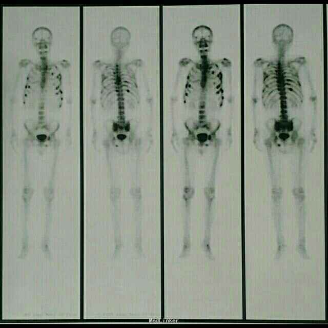 核医学全身骨扫描 诊断 处理 前列腺恶性肿瘤 随访 讨论 多发骨转移