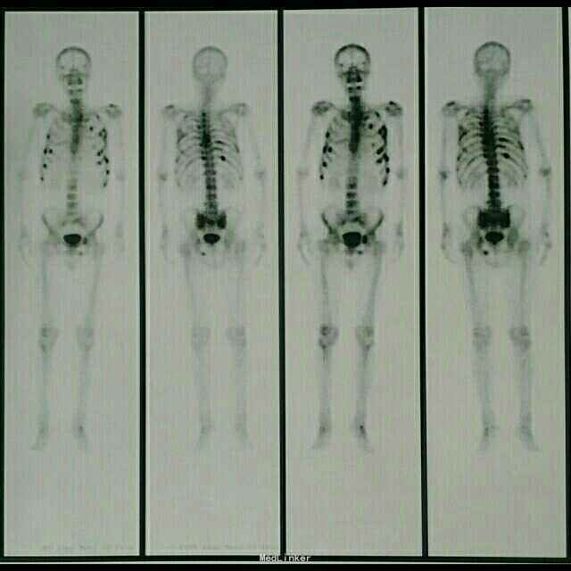 核医学全身骨扫描 诊断 处理 前列腺恶性肿瘤 随访 讨论 多发骨转移