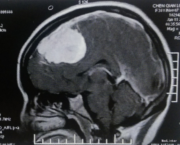 双侧额叶窦旁镰旁巨大脑膜瘤