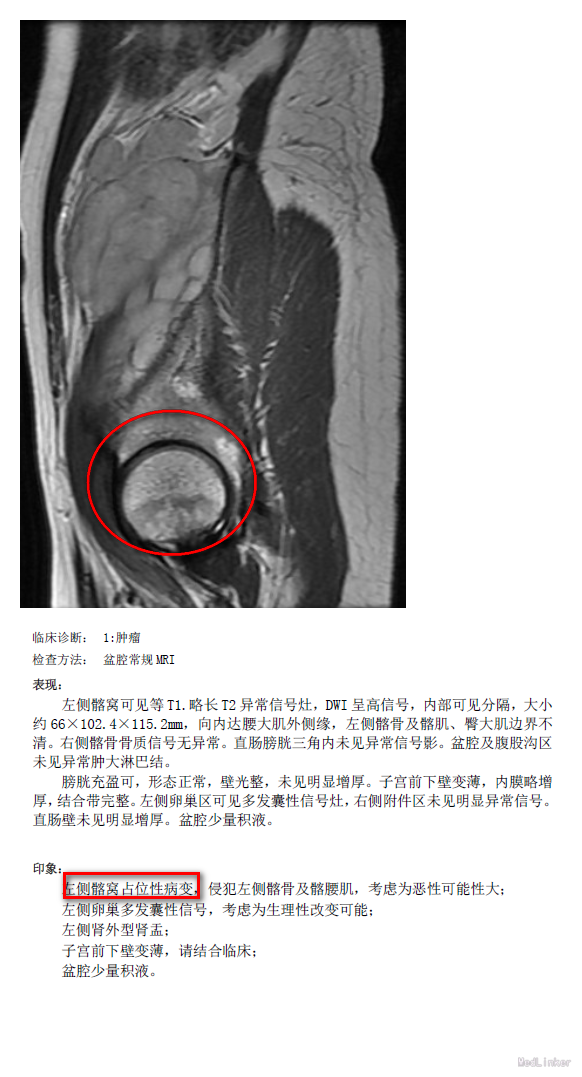 左髂窝恶性肿瘤一例