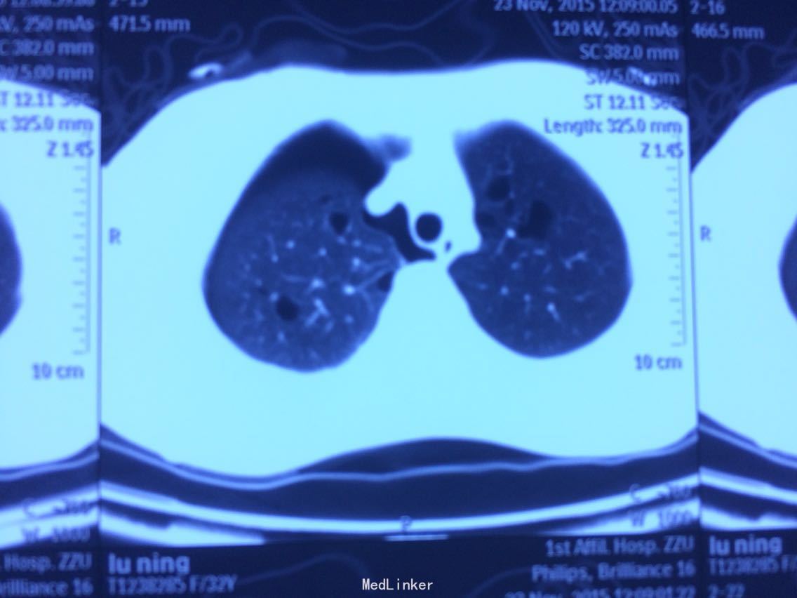 左上叶肺癌根治性手术治疗1例 - 病例中心(诊疗助手) - 爱爱医医学网