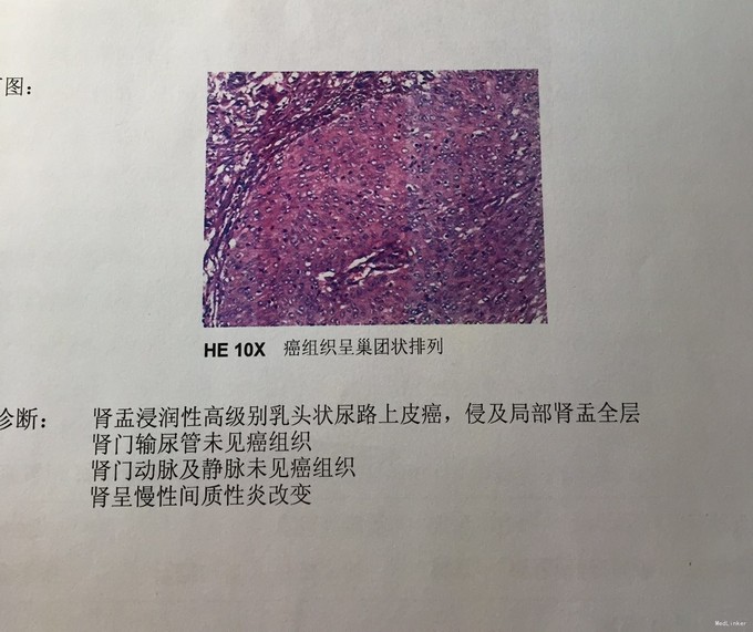 肾癌术后1月发现膀胱种植1例