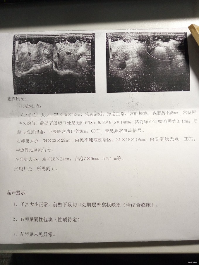 子宫疤痕憩室1例