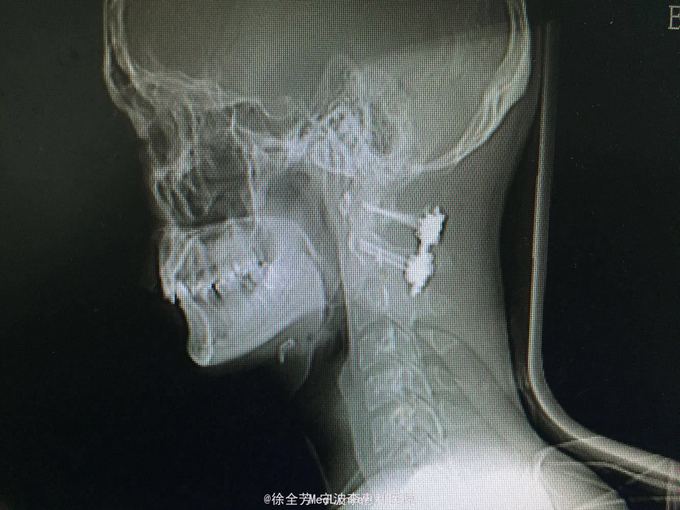 颈椎齿状突骨折后路固定(非融合)