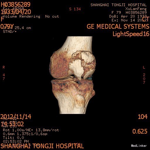 粉碎性髌骨骨折