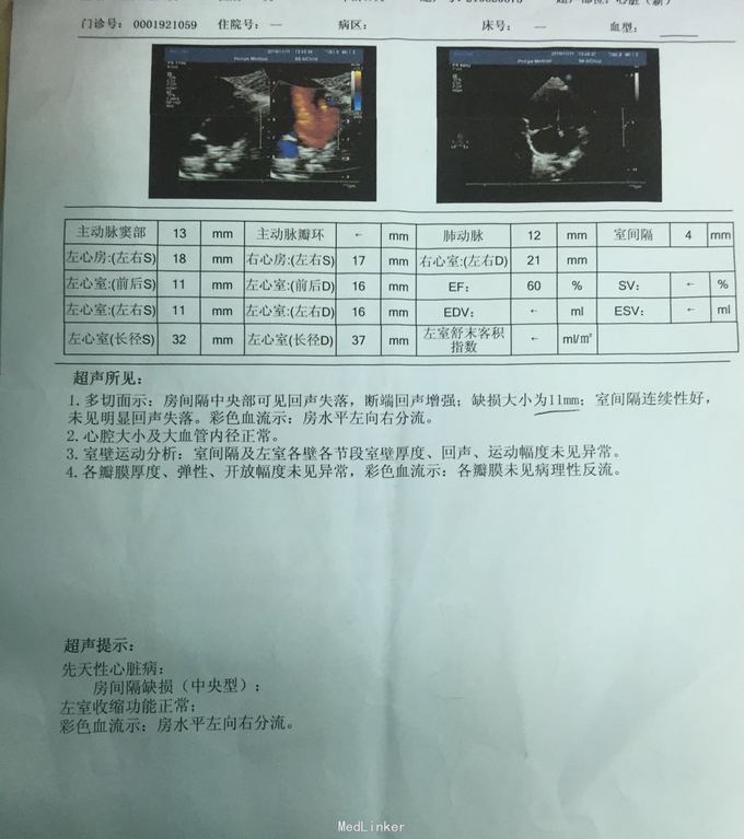 先心，房缺