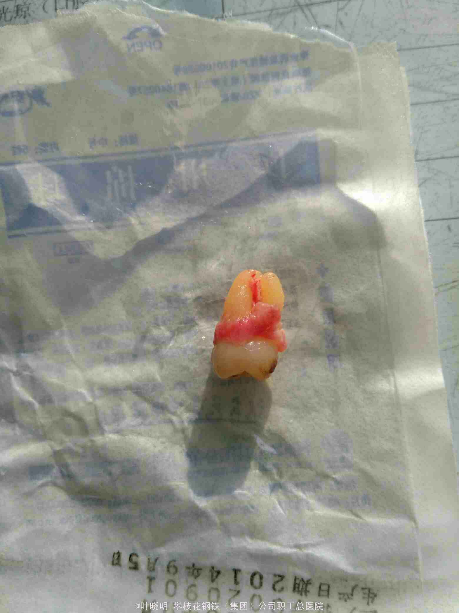 下颌阻生牙超声骨刀微创一例 - 微医（挂号网）