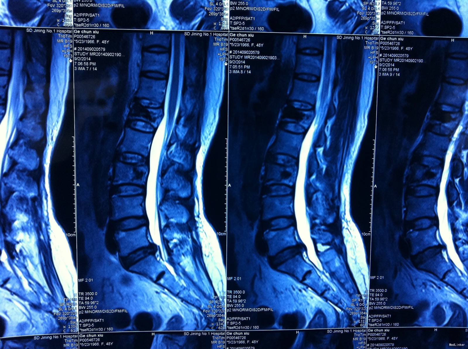 我省首例OLIF腰椎融合术在湘雅三医院脊柱外科成功开展 - 中南大学湘雅三医院