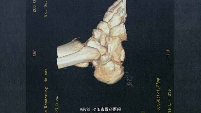 跟骨粉碎性骨折