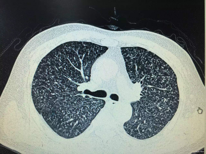 粟粒型肺结核