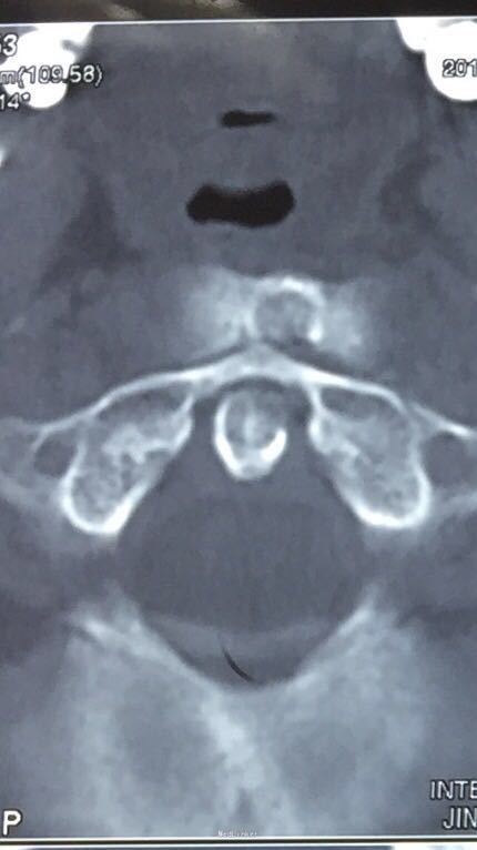 寰枢椎脱位伴齿状突骨折