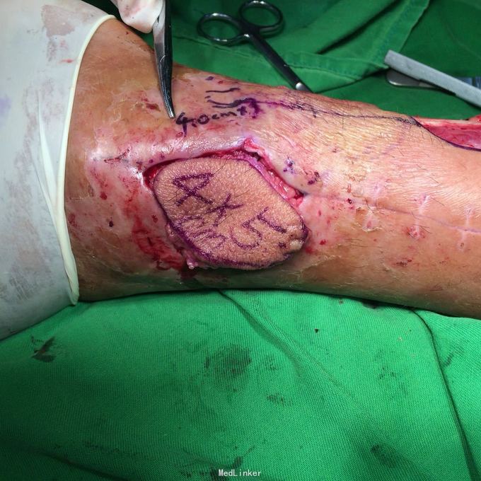 右腓骨下段开放性骨折术后感染致皮肤软组织坏死钢板外漏一例