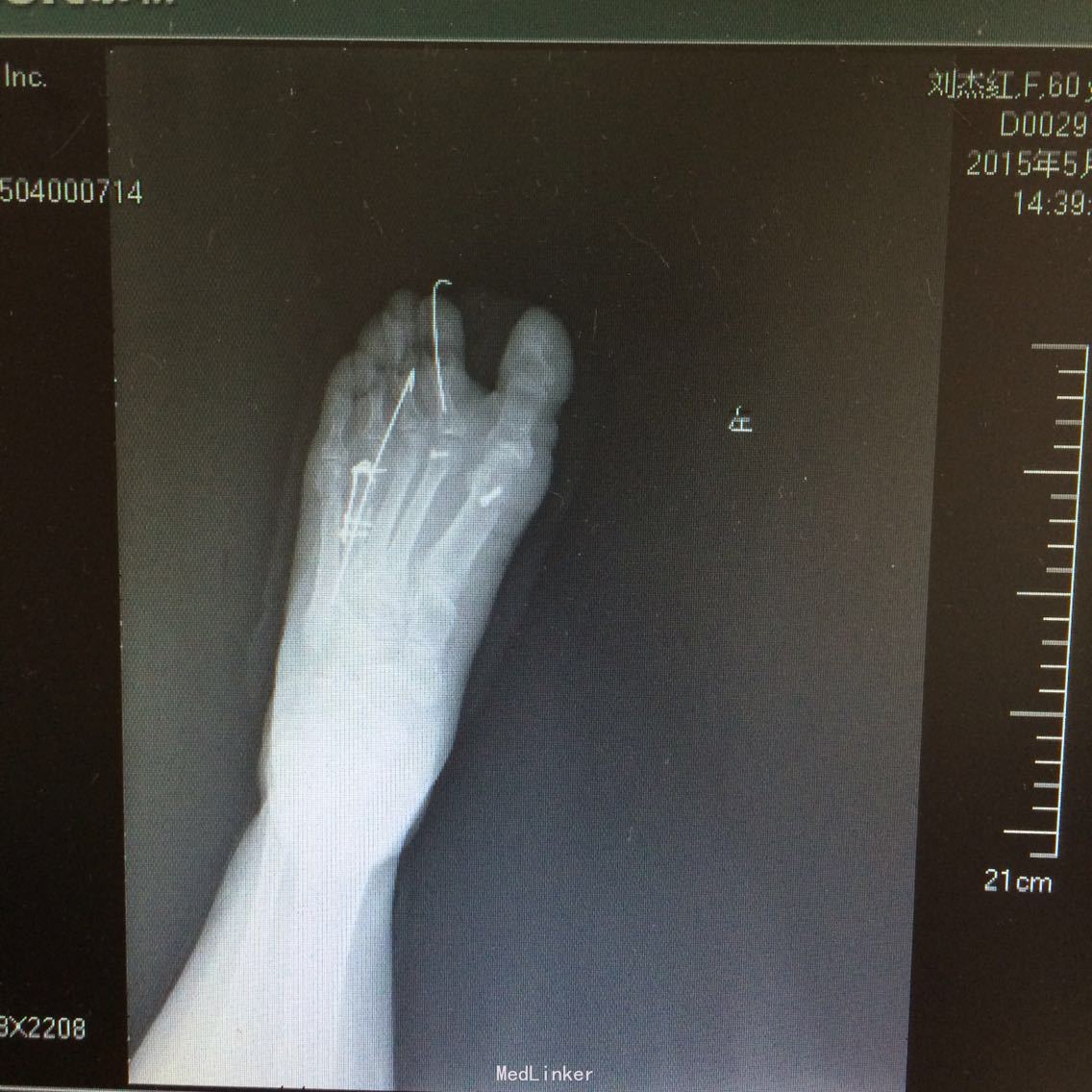 左脚第5趾骨骨折 之 治疗+生活日常记录（2021.11.2～康复进行时） - 知乎