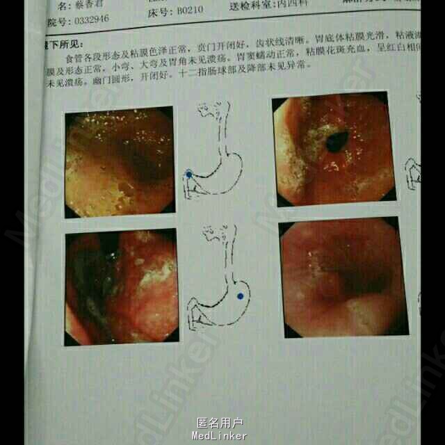 极重度贫血1例--痔疮出血?
