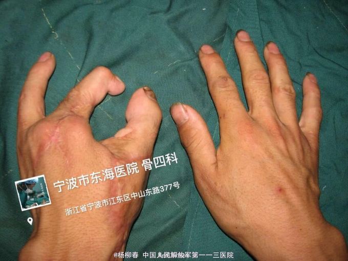 手功能重建(拇指全形再造)