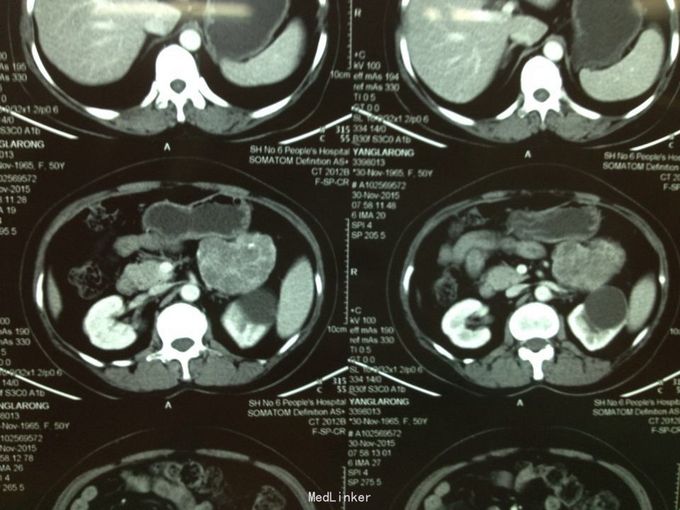 胰体尾部浆液性囊腺瘤一例