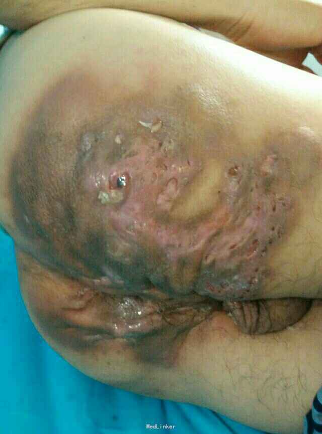 主诉 病史 肛周及臀部肿胀疼痛流脓2年余.