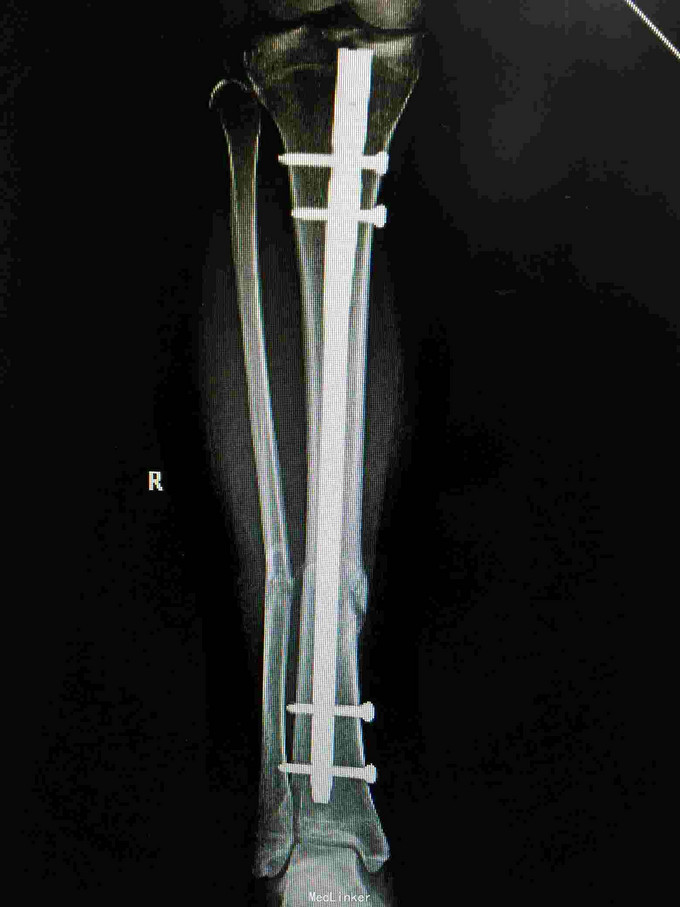 胫骨陈旧性骨折畸形生长采用腓骨截骨胫骨闭合复位髓内钉固定术