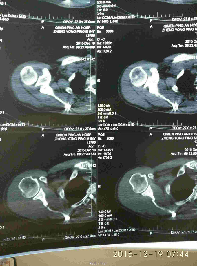 右肩峰及肩胛骨骨折