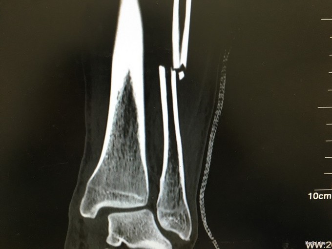 左胫腓骨远端粉碎性骨折并踝关节半脱位