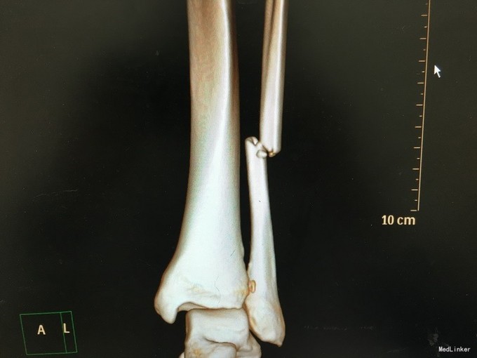 左胫腓骨远端粉碎性骨折并踝关节半脱位