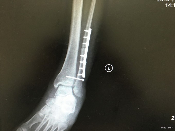 左胫腓骨远端粉碎性骨折并踝关节半脱位