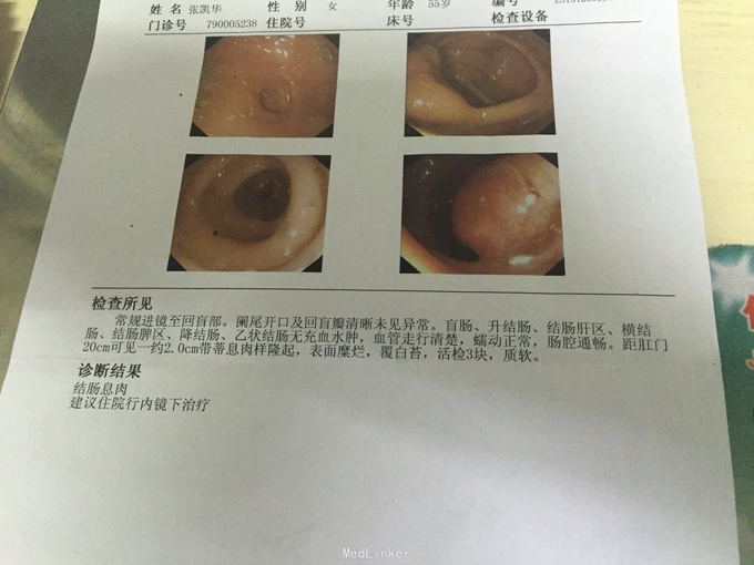 结肠息肉恶变1例