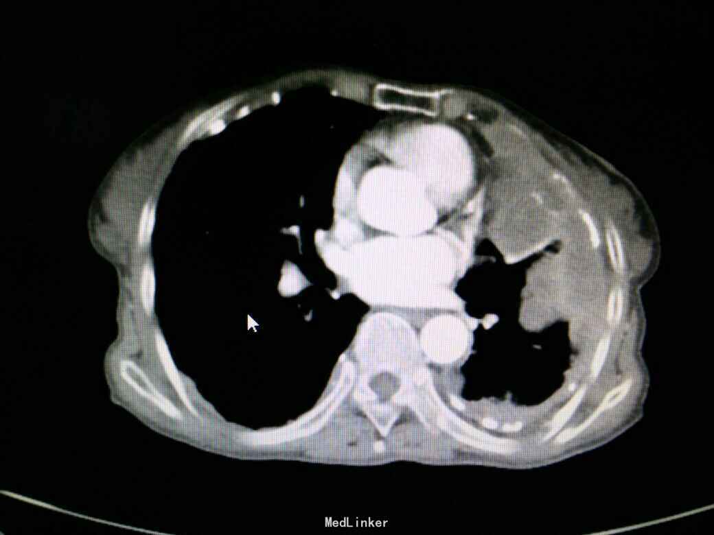 胸腺肿瘤的病理和影像学诊断（胸腺瘤篇） - 知乎
