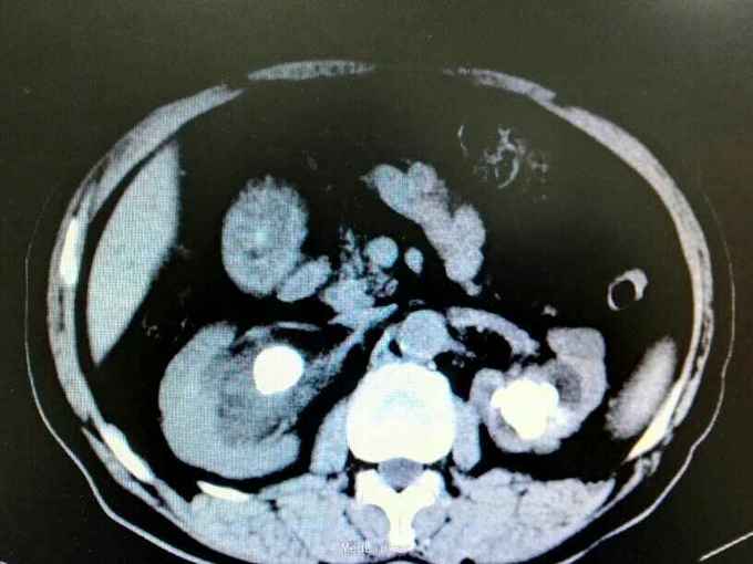 双肾铸型结石伴左肾萎缩一例