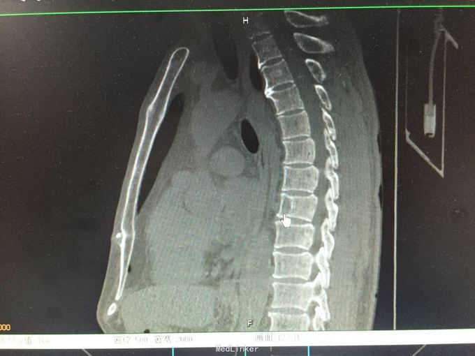 甲状腺癌骨转移一例