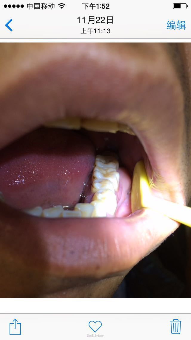 左下后牙牙龈瘤切除术