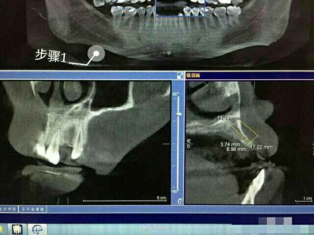 牙槽嵴缺损之3d植骨详解