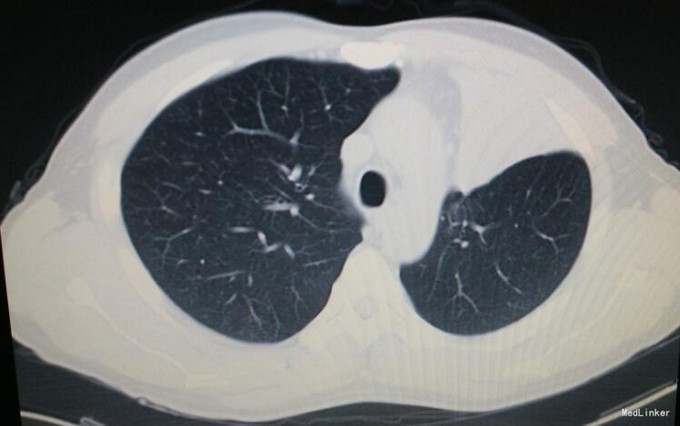 胸部ct提示:左上支气管阻塞伴左上肺不张.纤支镜提示:左上肺鳞癌.