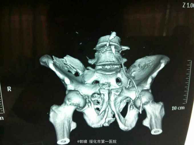 右髂骨骨折术后切口不愈合二个月