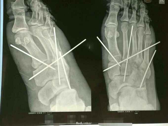 跖骨基底骨折伴跗跖关节脱位
