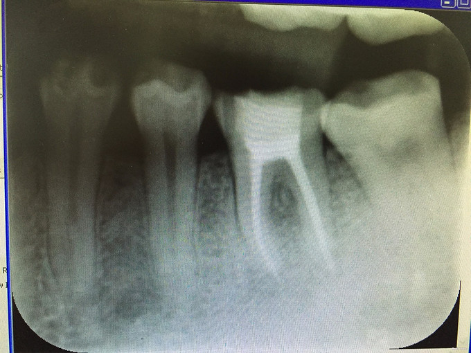 左下后牙根尖周炎一例