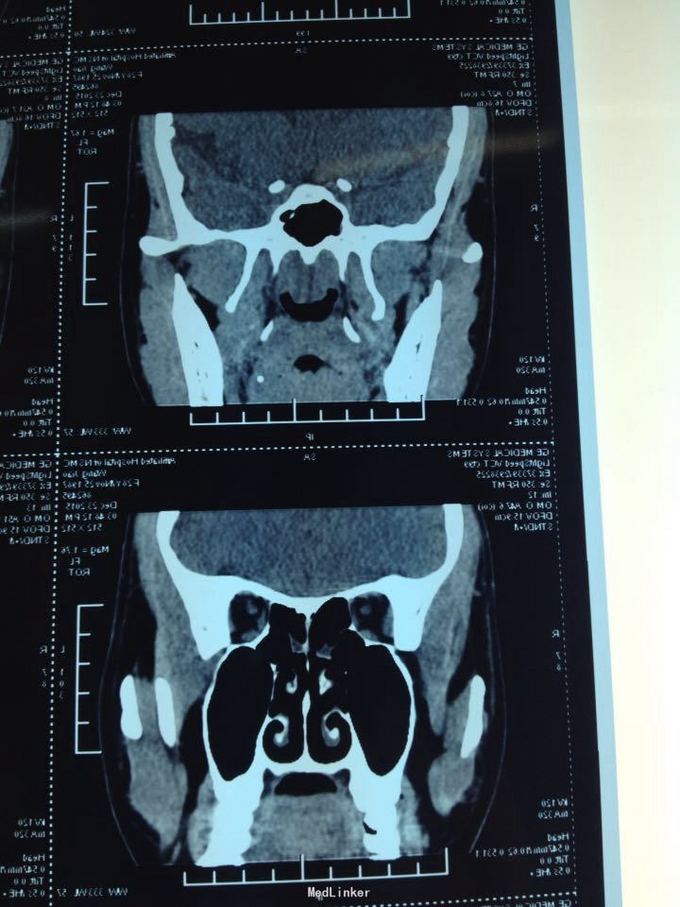 成人腺样体肥大,慢性扁桃体炎1例