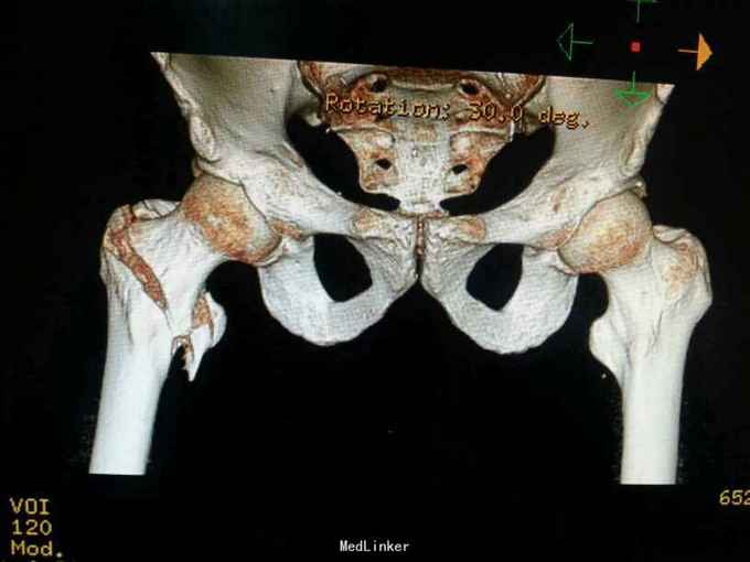摔伤导致右侧股骨粗隆间骨折