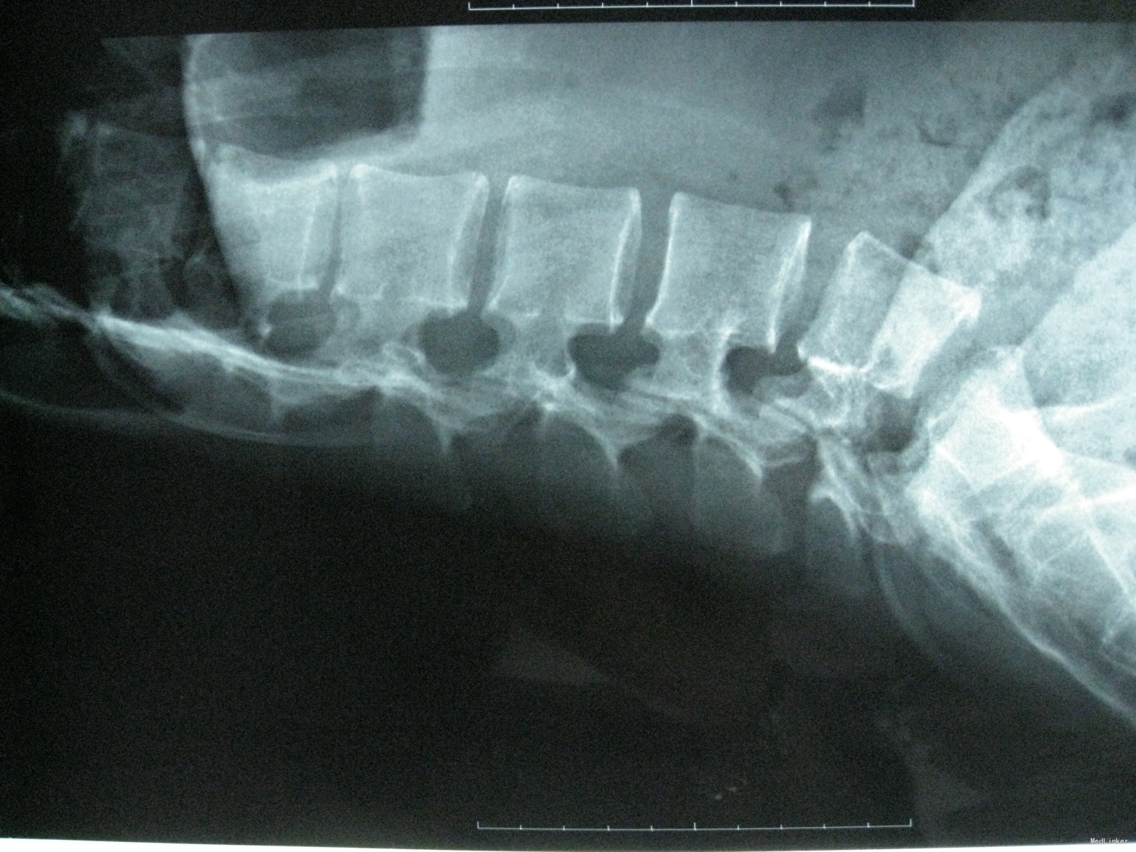 腰椎滑脱8年，通过椎弓根螺钉系统手术完美复位（附术后一年随访影像检查） - 知乎