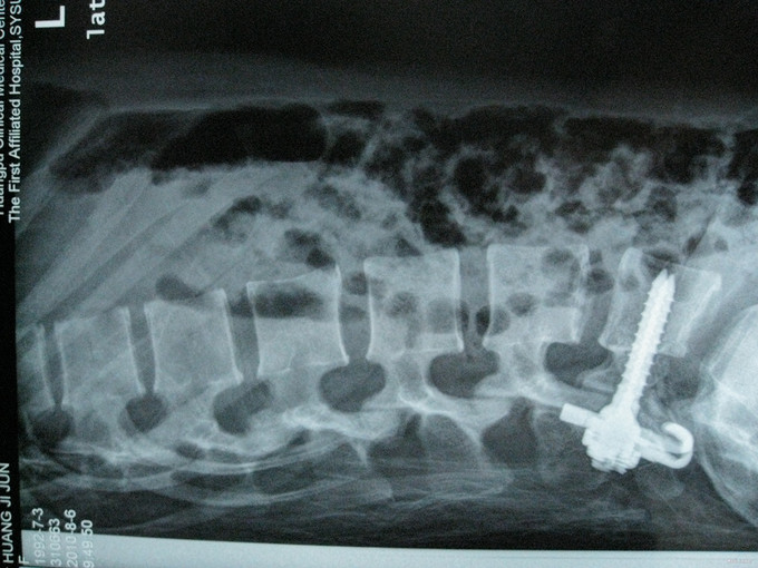 腰椎峡部裂1例