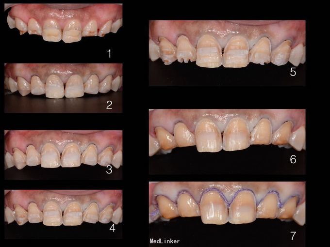 重度四环素牙釉质发育不全……瓷贴面修复