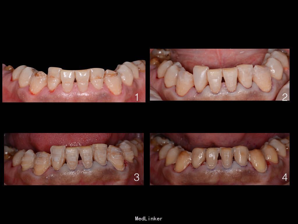 修复案例分享：四环素牙，全瓷贴面修复 - 知乎